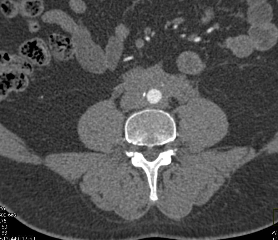 Retroperitoneal Fibrosis Encases the Aorta - CTisus CT Scan