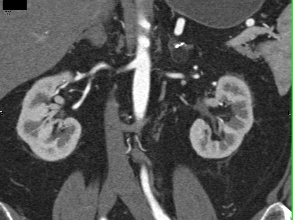 Normal CTA of the Renal Arteries - CTisus CT Scan