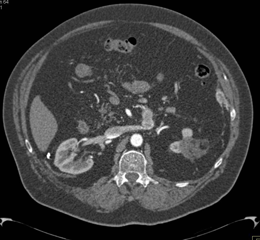 Cryoablation of the Left Kidney - CTisus CT Scan