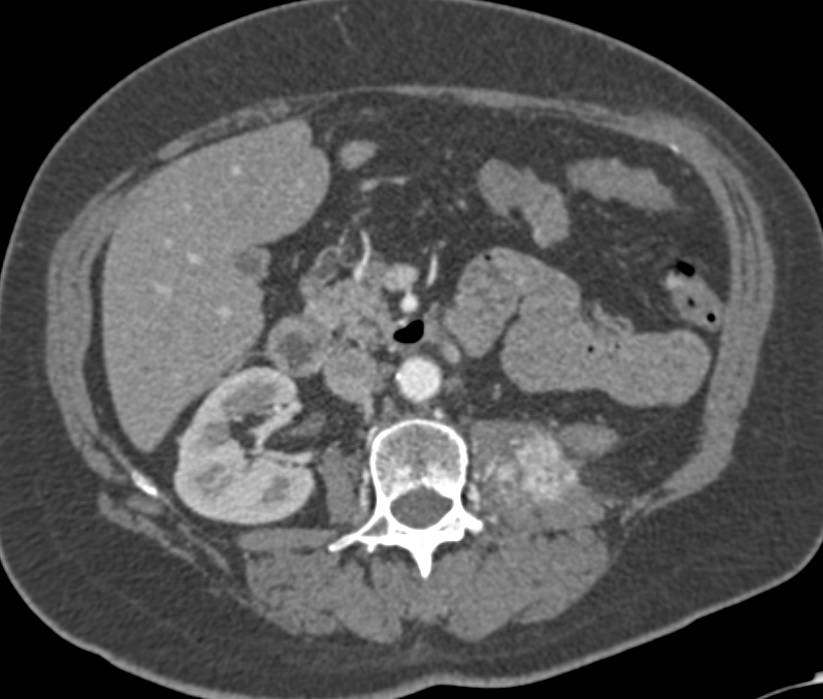 Recurrent Renal Cell Carcinoma in Left Psoas Muscle - CTisus CT Scan