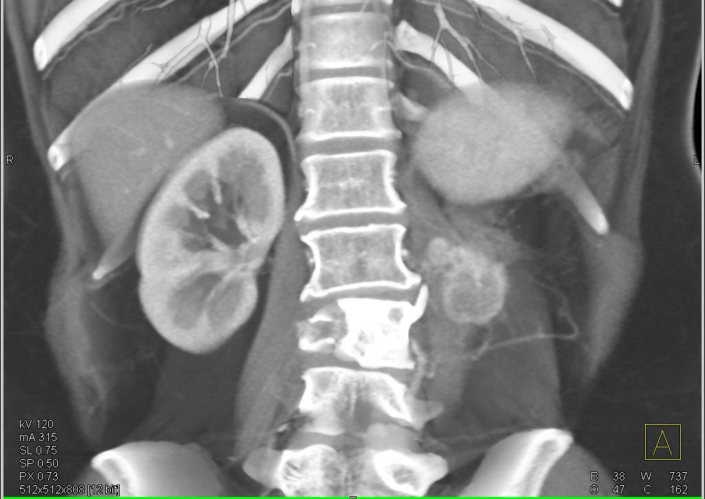 Recurrent Renal Carcinoma in the Left Psoas Muscle - CTisus CT Scan