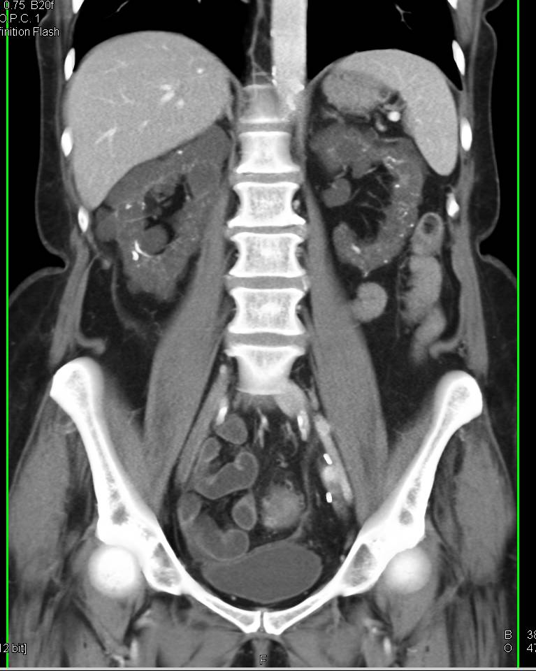 Polycystic Kidney Disease with Successful Left Renal Transplant