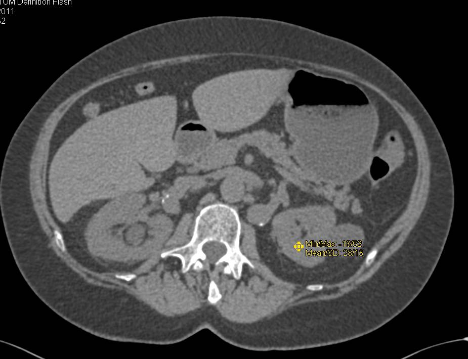 Renal Artery Aneurysms - CTisus CT Scan