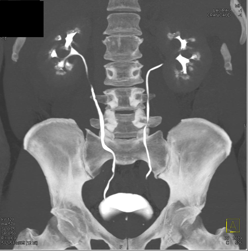 Perirenal Lymphoma Right Kidney - CTisus CT Scan