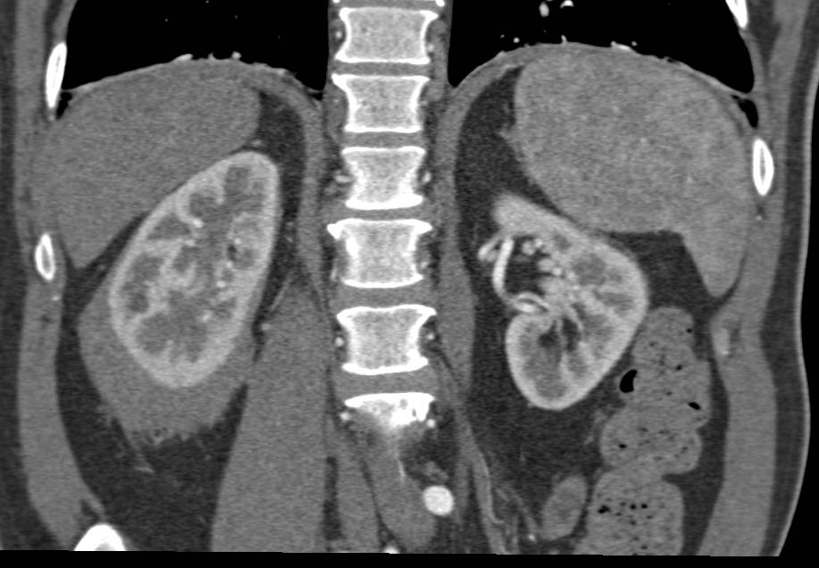 Perirenal Lymphoma Right Kidney - CTisus CT Scan