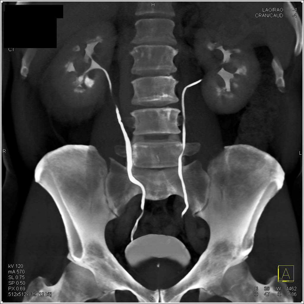 Renal Lymphoma of the Right Kidney - CTisus CT Scan