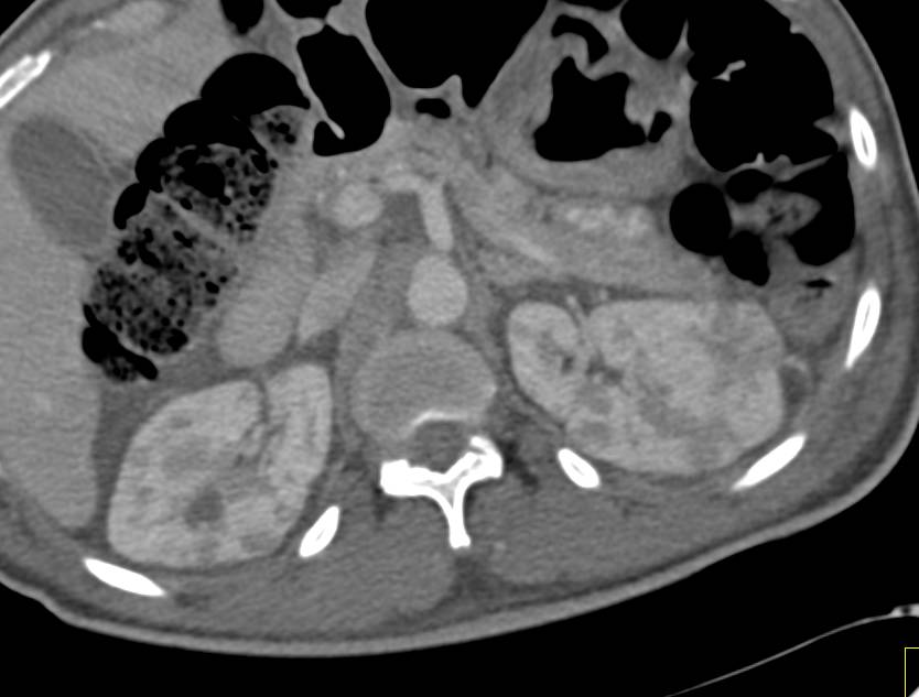 Renal Lymphoma with Multiple Renal Masses - CTisus CT Scan