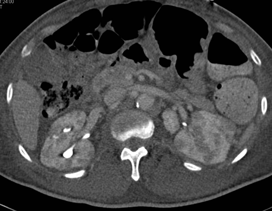 Renal Lymphoma with Multiple Masses in Both Kidneys - CTisus CT Scan