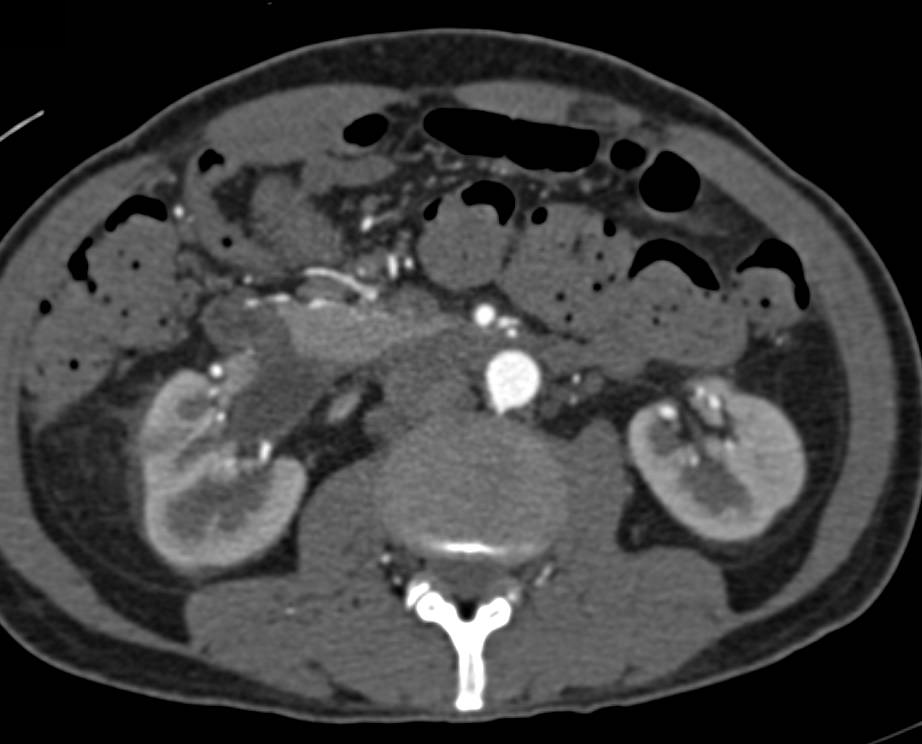 Multiple Renal Arteries in a Potential Donor - CTisus CT Scan