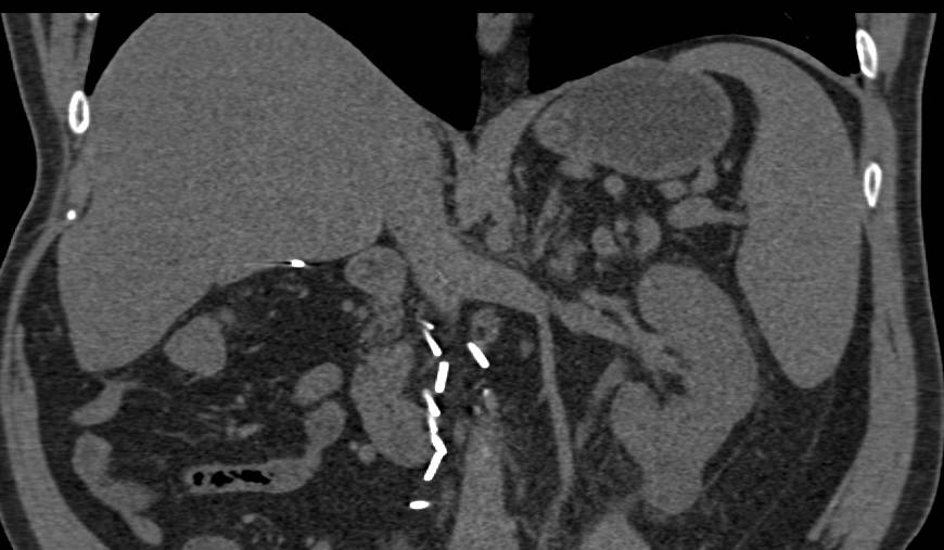 Right Nephrectomy and Carcinoma Lower Pole Left Kidney - CTisus CT Scan