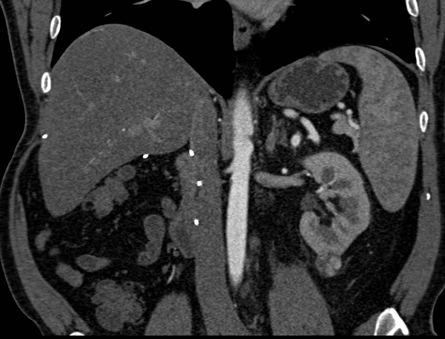 2 cm Renal Cell Carcinoma Lower Pole Left Kidney - CTisus CT Scan