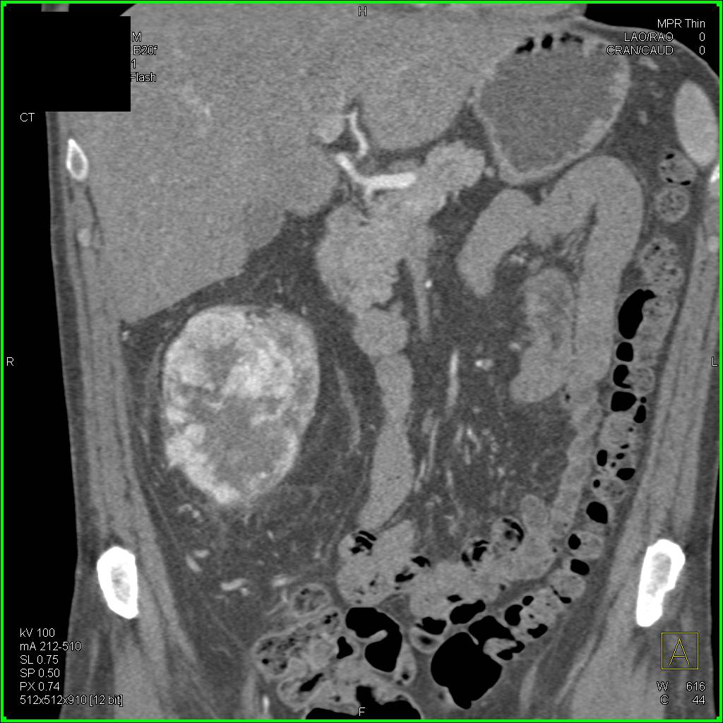 Renal Cell Carcinoma Looks a bit Like an Oncocytoma - CTisus CT Scan