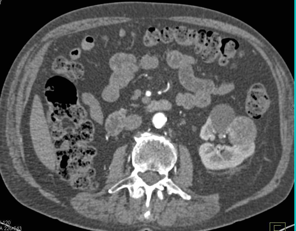 Multiple Left Renal Cell Carcinomas in a Patient with a History of Renal Cell Carcinoma - CTisus CT Scan