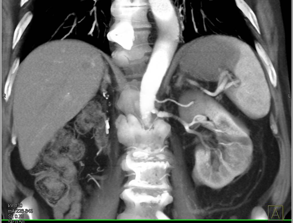 Right Nephrectomy with New Renal Cell Carcinoma (RCC) in the Left Kidney - CTisus CT Scan