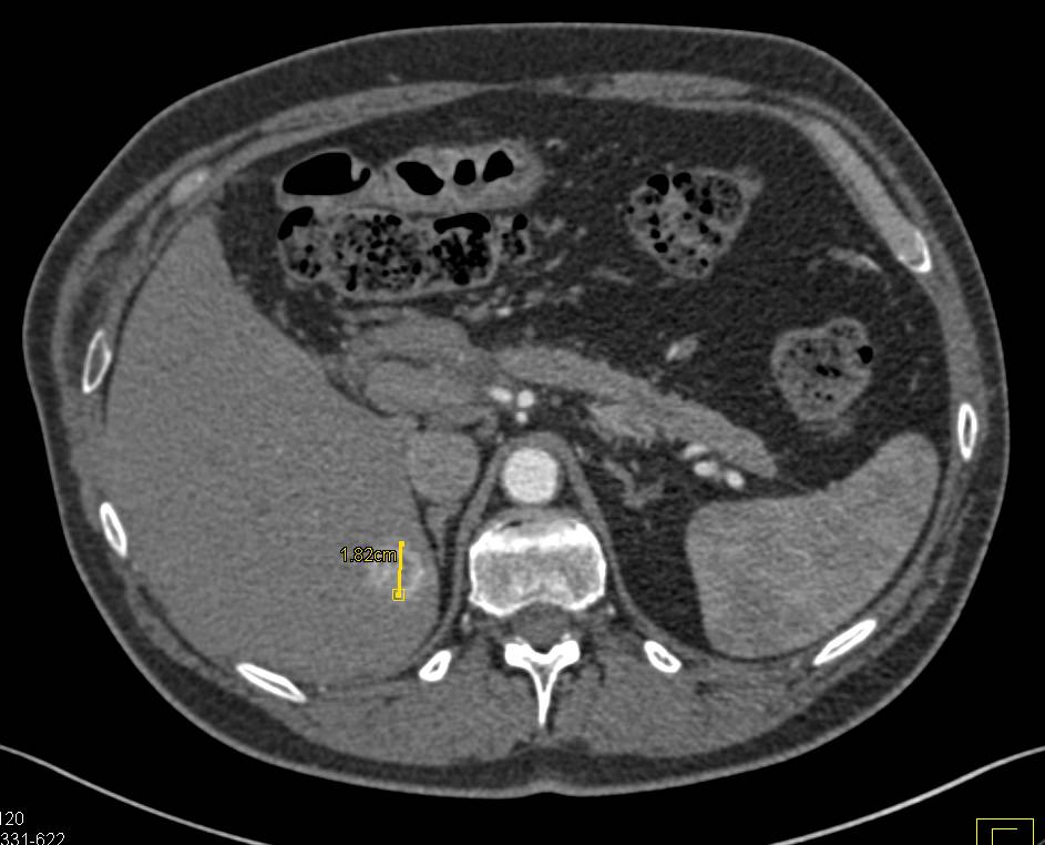 Metastatic Renal Cell Carcinoma - CTisus CT Scan