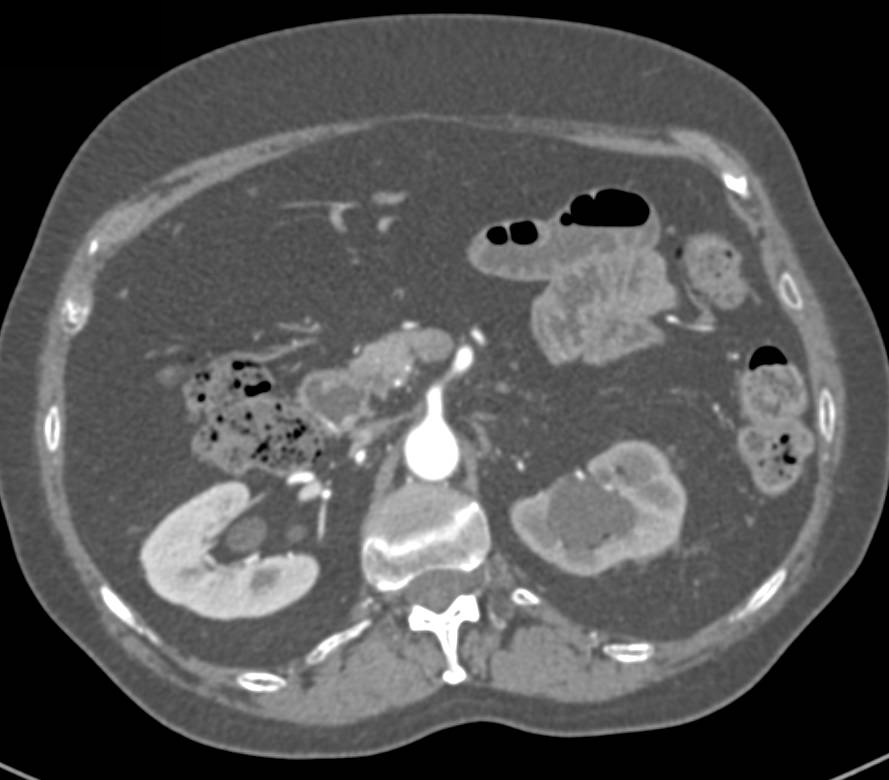 Stent in Left Renal Pelvis in 3D - CTisus CT Scan