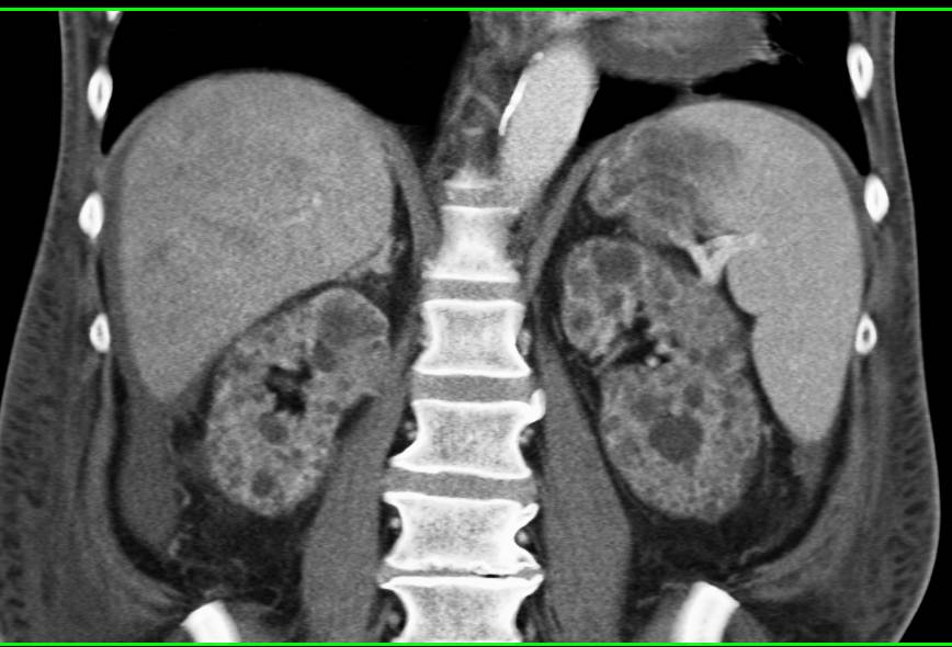 End Stage Renal Disease with Multiple Renal Cysts - CTisus CT Scan