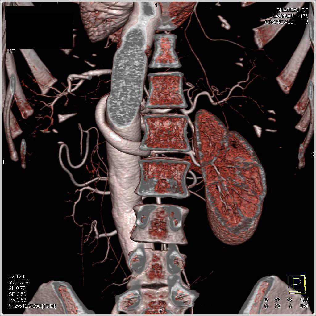 CTA Defines Reimplanted Right Renal Artery - CTisus CT Scan