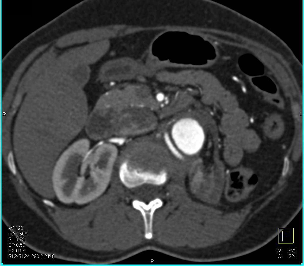 Infarcted Left Kidney and Reimplanted Right Renal Artery - CTisus CT Scan