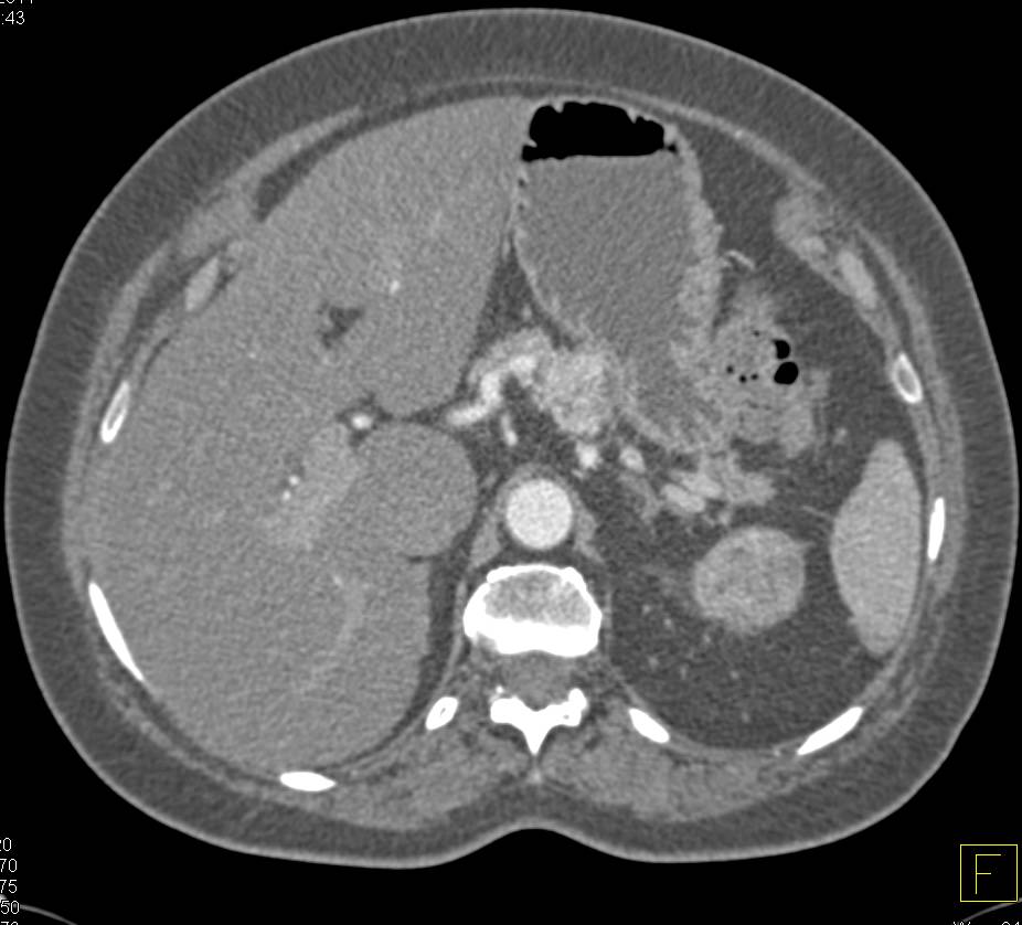 Left Renal Cell Carcinoma in Patient with Prior Right Nephrectomy for Renal Carcinoma - CTisus CT Scan