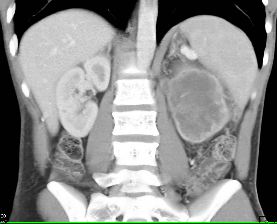 Clear Cell Renal Cell Carcinoma With Para-aortic Adenopathy - CTisus CT Scan