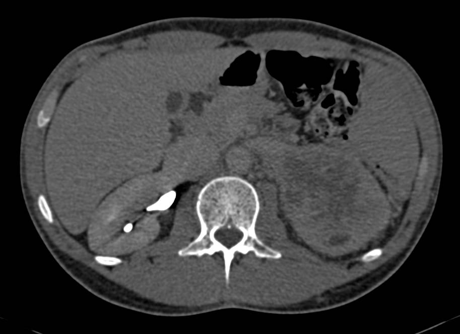 Transitional Cell Carcinoma Left Kidney - CTisus CT Scan