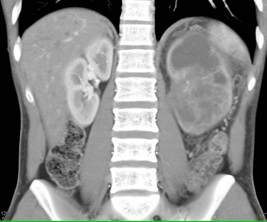 Transitional Cell Carcinoma Left Kidney - CTisus CT Scan