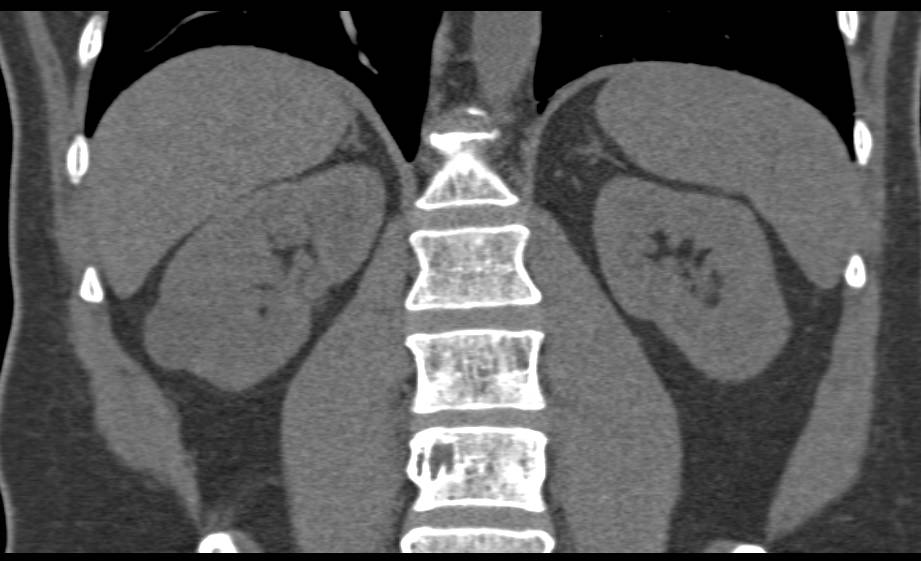 High Density Right Renal Cyst - CTisus CT Scan