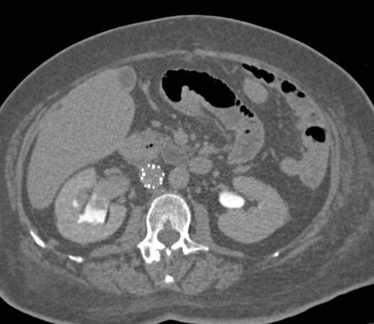 Transitional Cell Carcinoma Right Kidney with Blood Clots in the Bladder - CTisus CT Scan