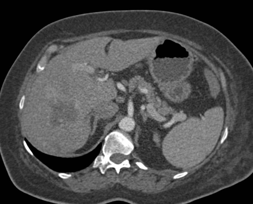 Transitional Cell Carcinoma Right Kidney - CTisus CT Scan