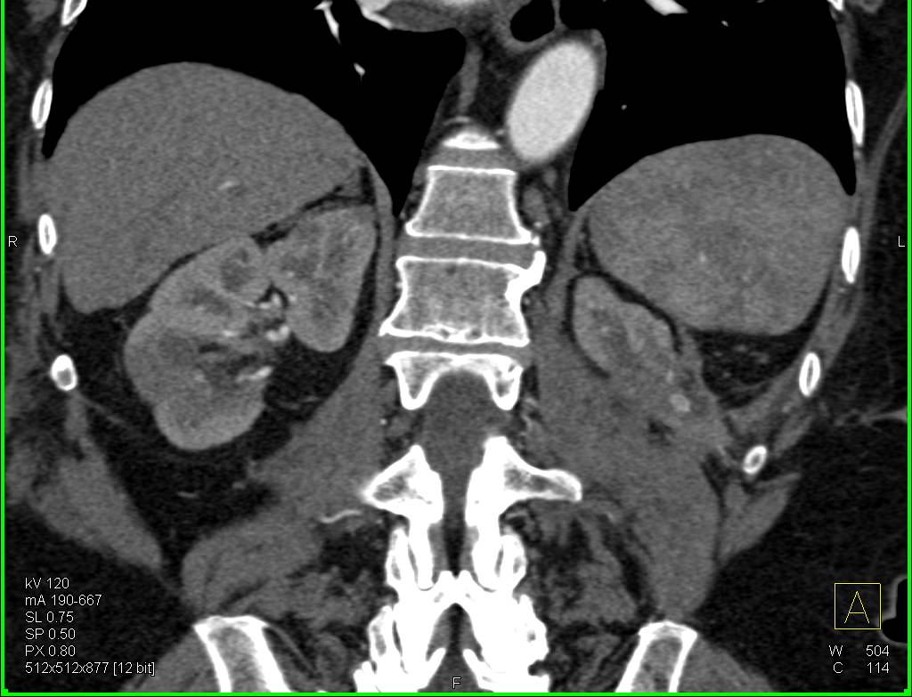 Multiple Vascular Renal Cell Carcinomas - CTisus CT Scan