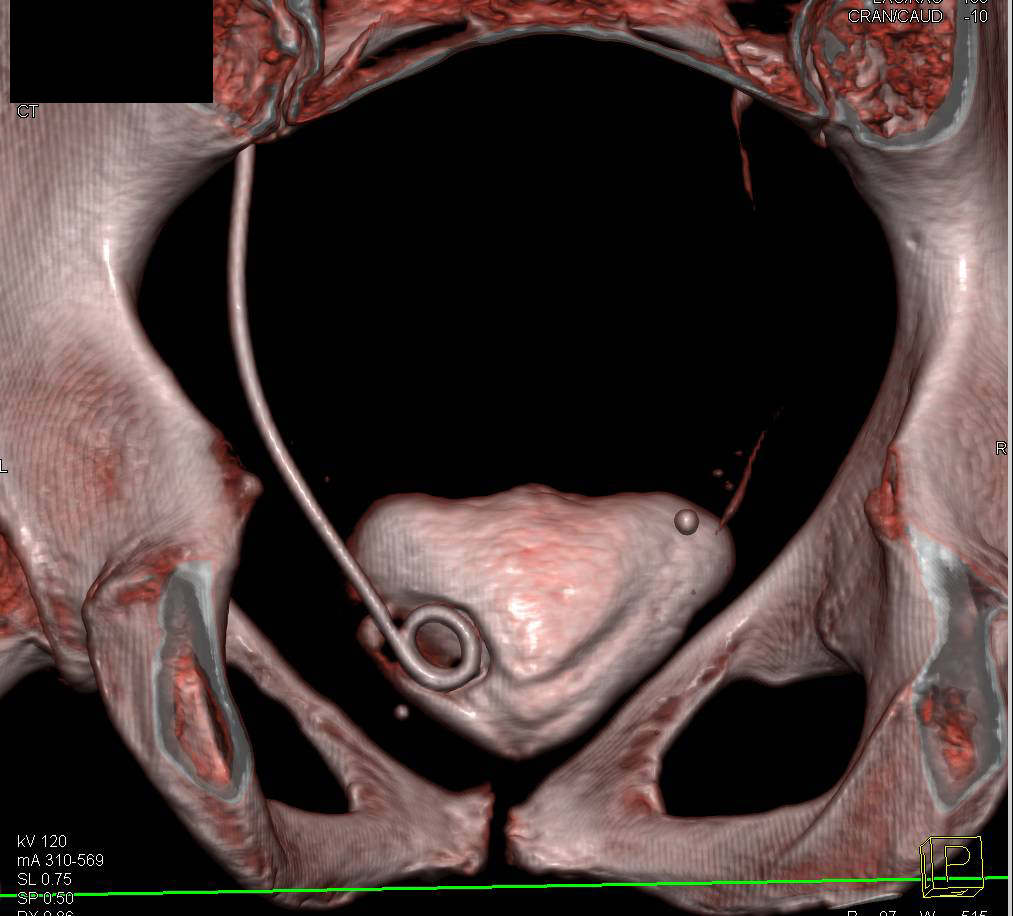 Double J Stent with Distal Stent Still in Distal Ureter Nicely Shown in 3D - CTisus CT Scan