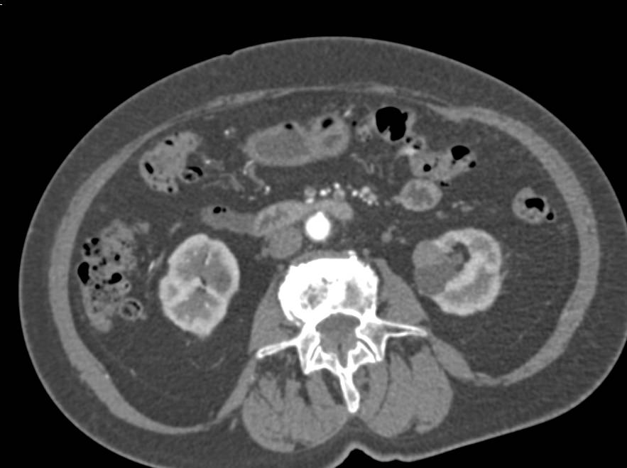 Renal Cell Carcinoma in the Wall of a Left Renal Cyst - CTisus CT Scan