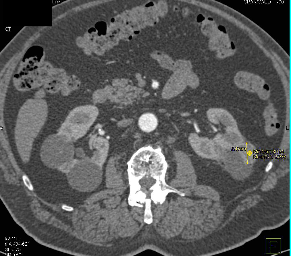 Renal Cell Carcinoma Arises in the Wall of a Cyst - CTisus CT Scan