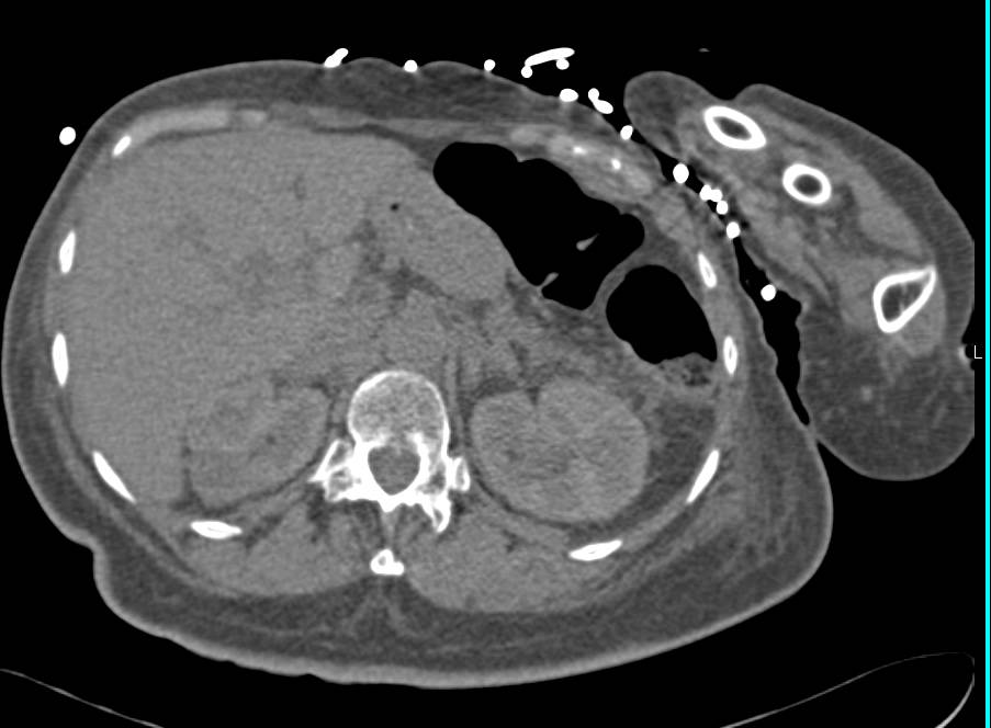 Multiple Renal Infarcts with Early Necrosis Seen as Well - CTisus CT Scan