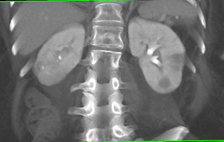 Acute Pyelonephritis Best Seen on Delayed Phase Imaging - CTisus CT Scan