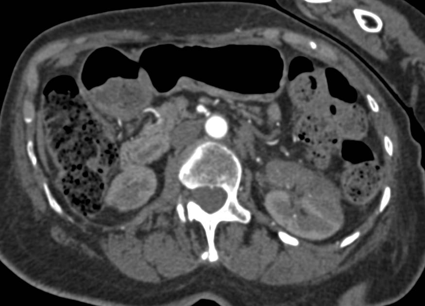 Acute Pyelonephritis - CTisus CT Scan