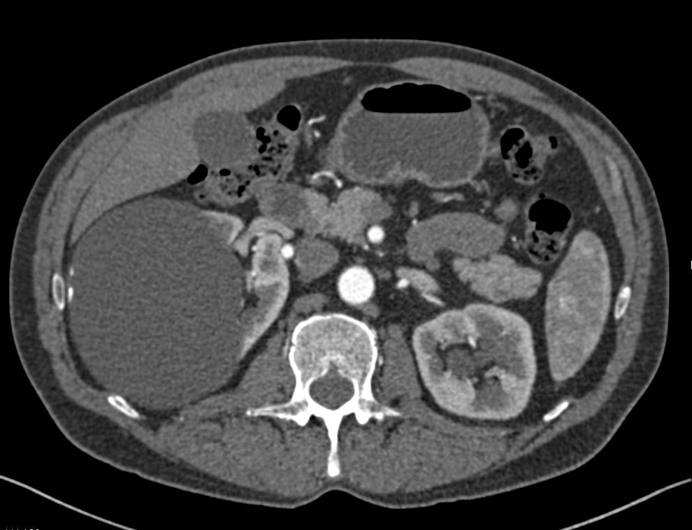 Bosniak 2 Cyst with Dense Calcification - CTisus CT Scan