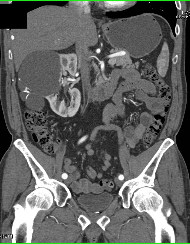 Bosniak 2 Right renal cyst - CTisus CT Scan