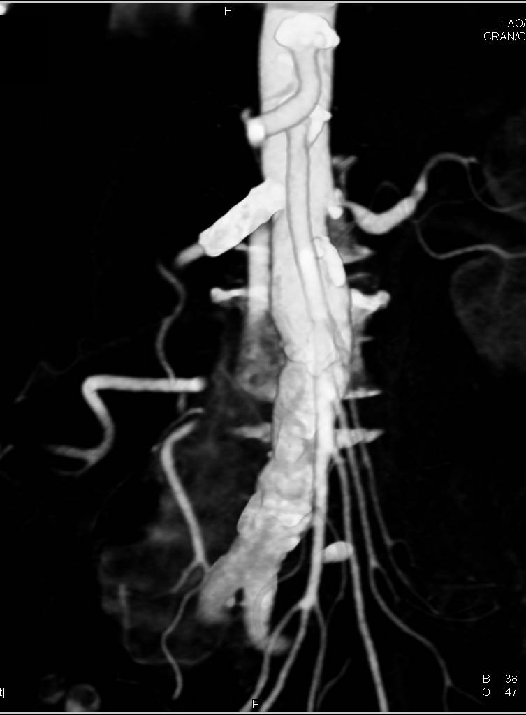 Patent Stent in the Right Renal Artery - CTisus CT Scan