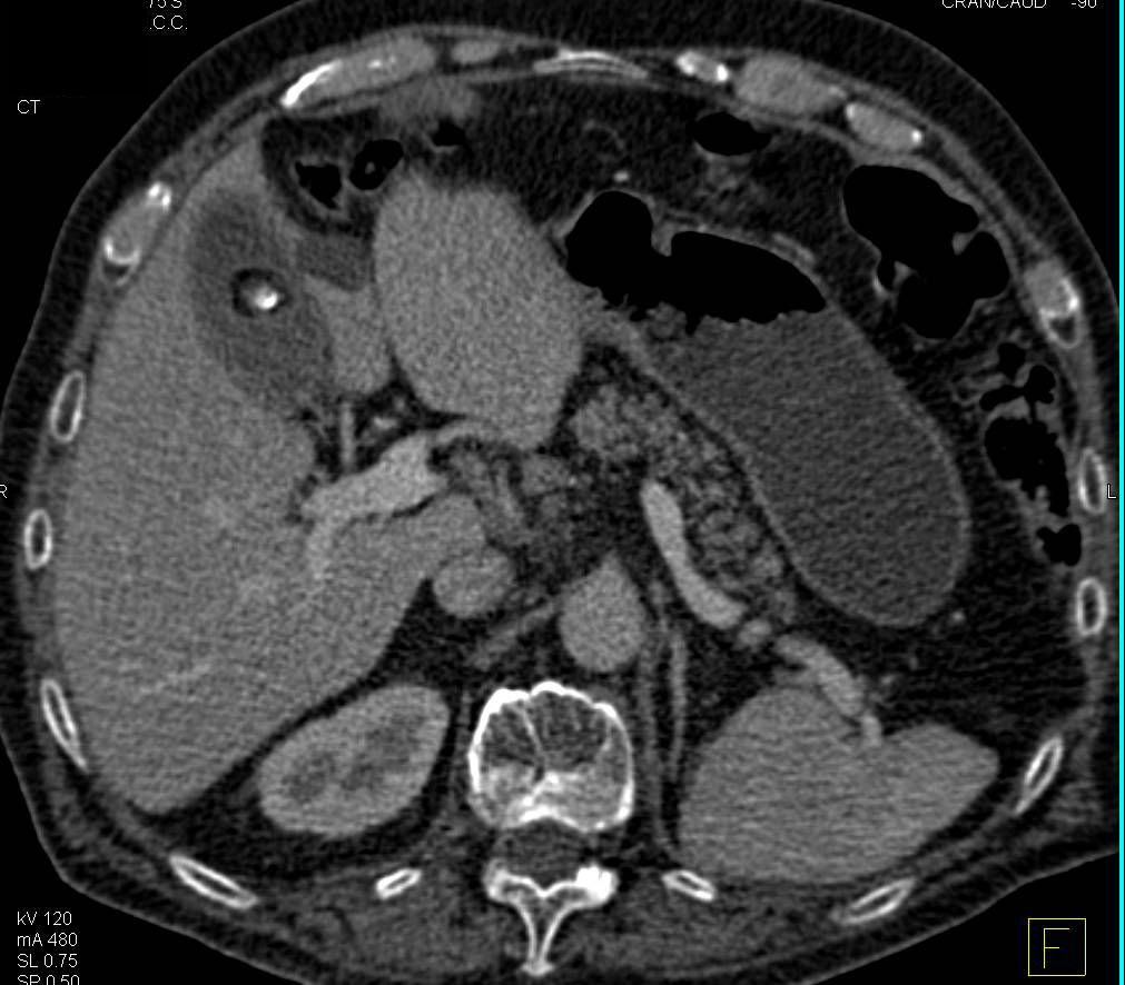 Recurrent Renal Cell Carcinoma Metastatic to the Spine - CTisus CT Scan