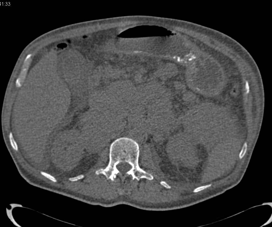 Renal Cell Carcinoma with Bulky Adenopathy - CTisus CT Scan