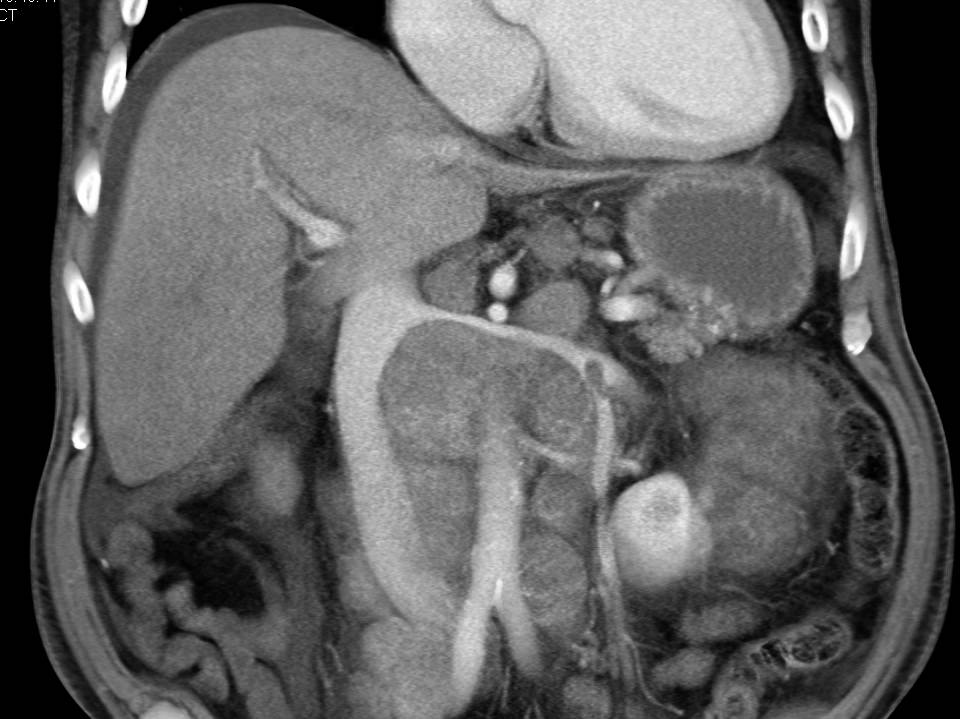 Renal Cell Carcinoma with Bulky Adenopathy Compresses the Inferior Vena Cava (IVC) - CTisus CT Scan