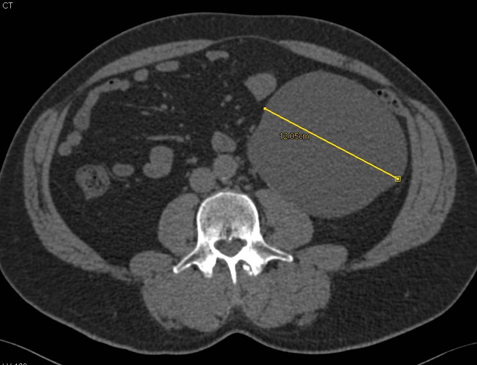 Bosniak I Cyst Left Kidney - CTisus CT Scan