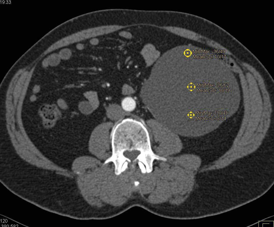 Simple Renal Cyst - CTisus CT Scan