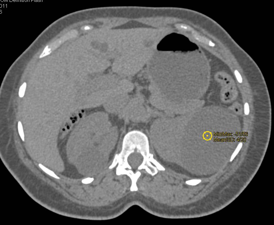 Multiple Renal Cysts - CTisus CT Scan