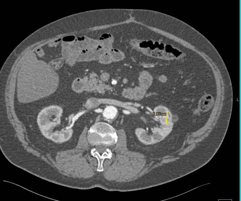 Incidental 1 cm Renal Cell Carcinoma - CTisus CT Scan