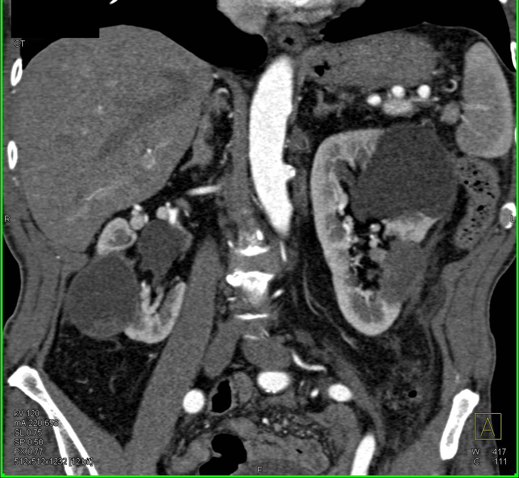 Complex Cystic Lesions with Ablations Both Kidneys - CTisus CT Scan