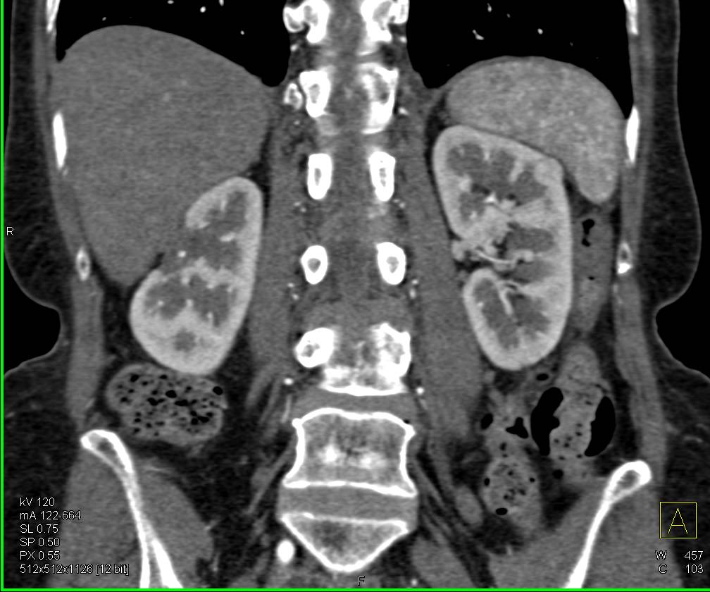 1 cm Nodule Upper Pole Left Kidney in Patient with Prior Right Partial Nephrectomy - CTisus CT Scan