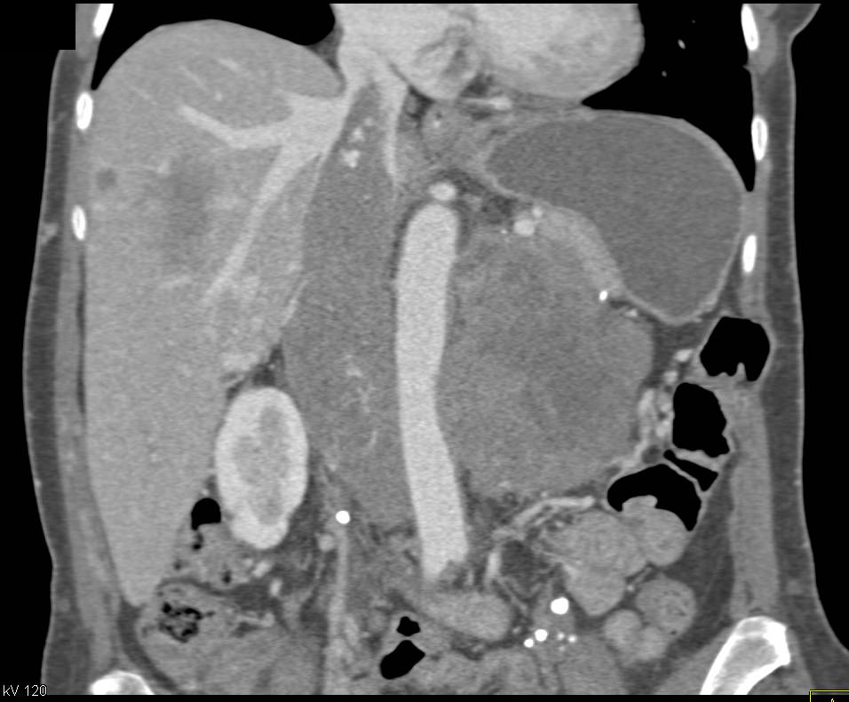 Recurrent Renal Cell Carcinoma with Adenopathy and Local Recurrence - CTisus CT Scan